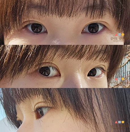 수술 후