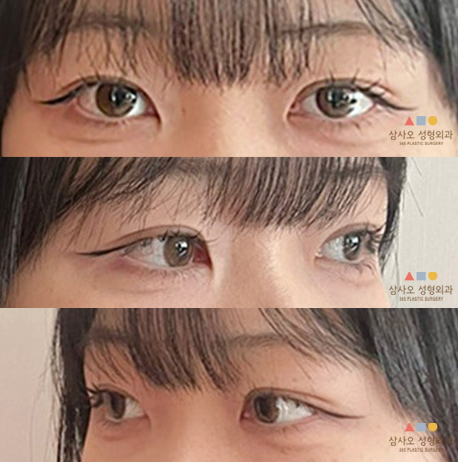 수술 후