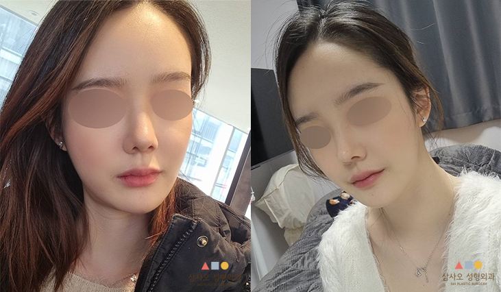 수술 후