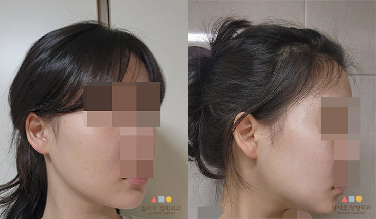 수술 후