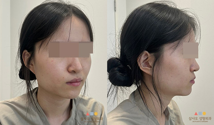 수술 전