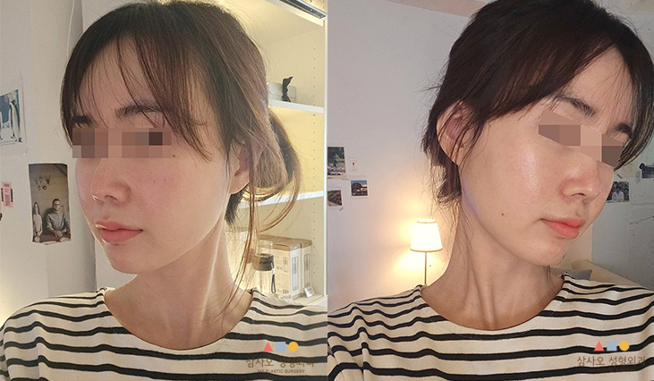 수술 후