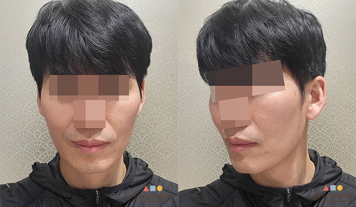 수술 전