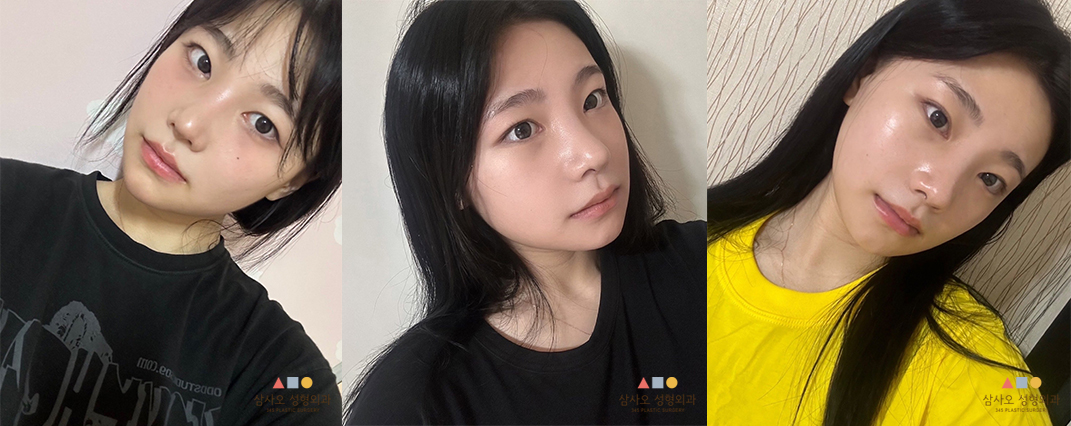 수술 후