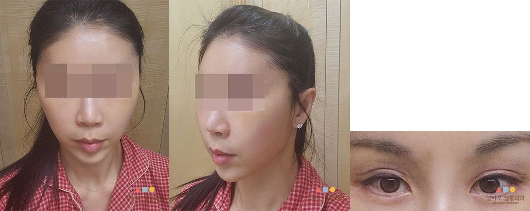 수술 후