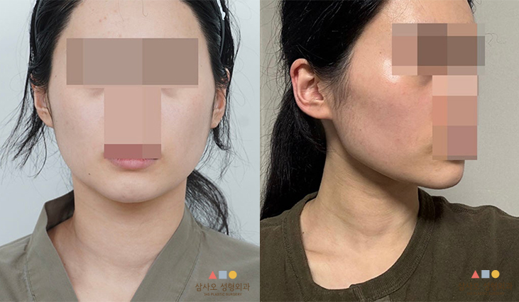 수술 전