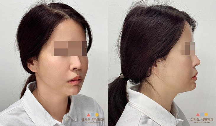 수술 후