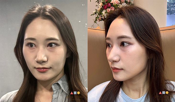 수술 전
