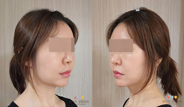 수술 후