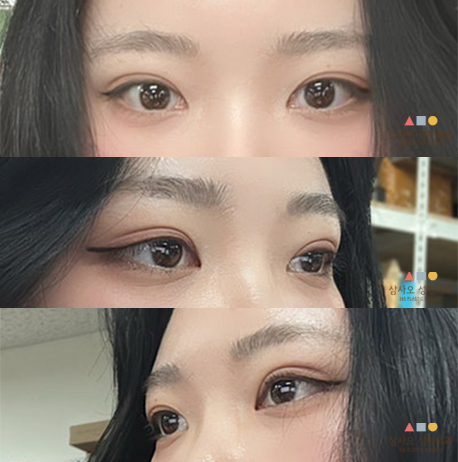수술 후