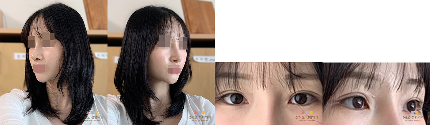 수술 후