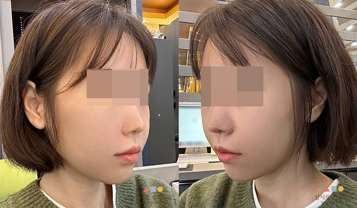 수술 후