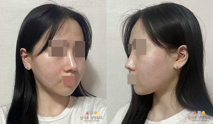 수술 후
