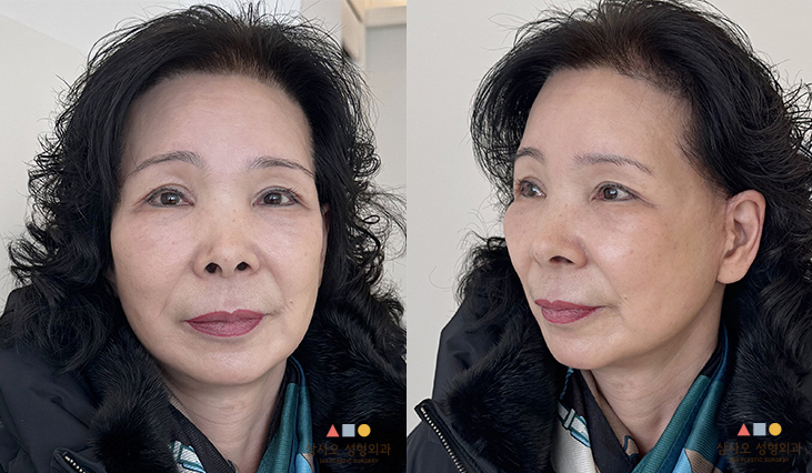 수술 후