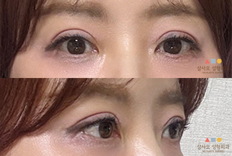 수술 후