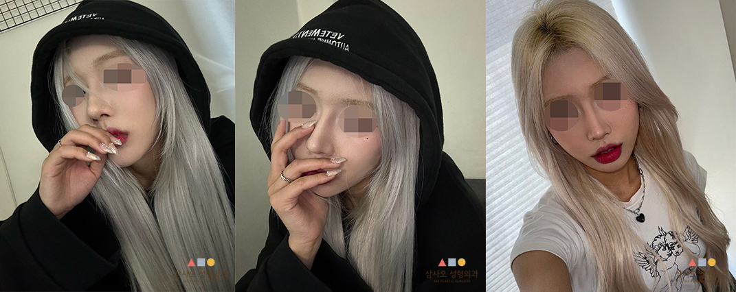 수술 후