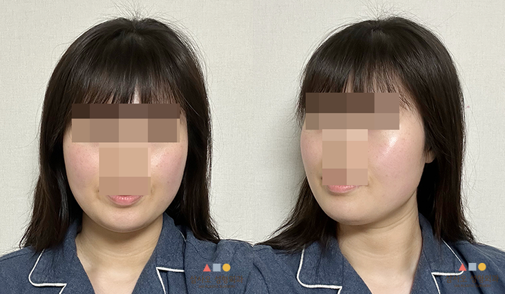 수술 후
