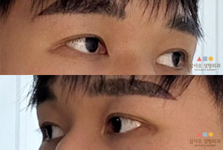 수술 후