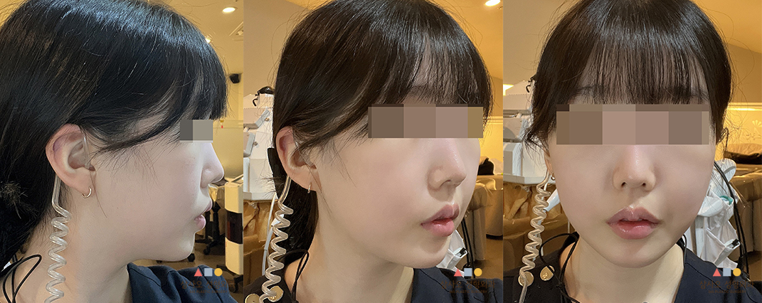 수술 후
