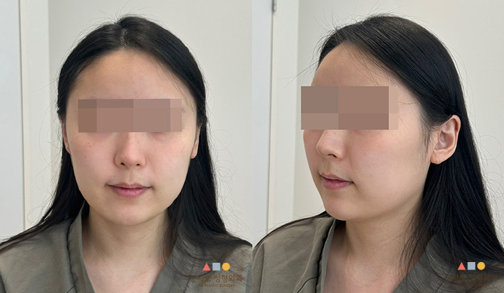 수술 전