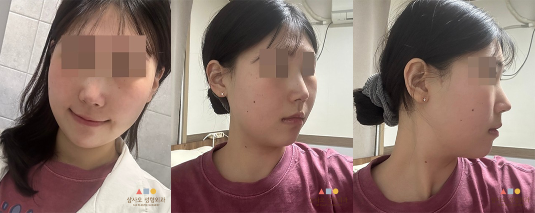 수술 후