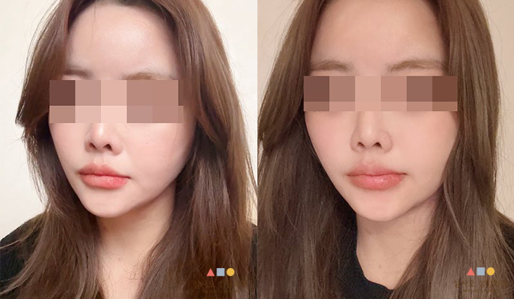 수술 후