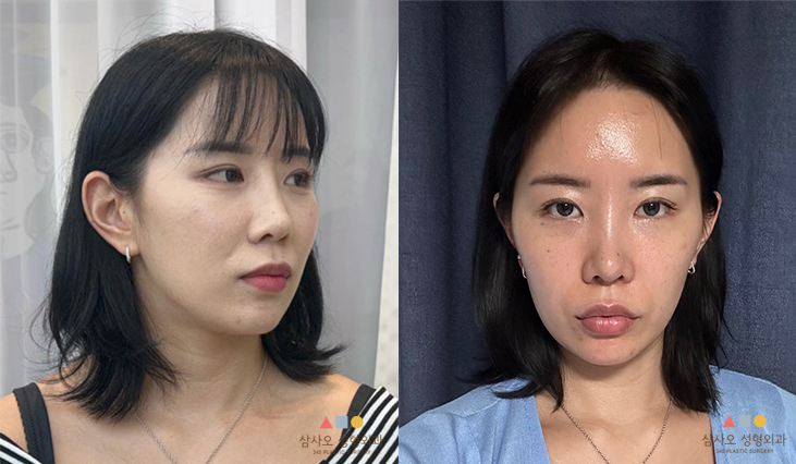 수술 전