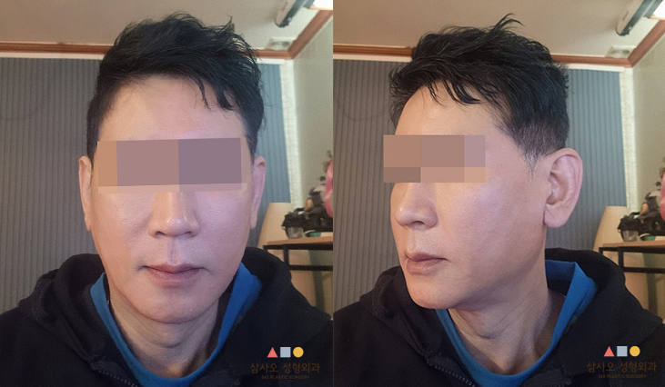 수술 후