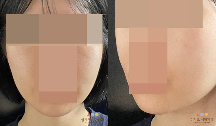 수술 후