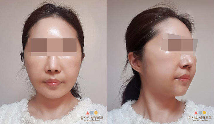 수술 후