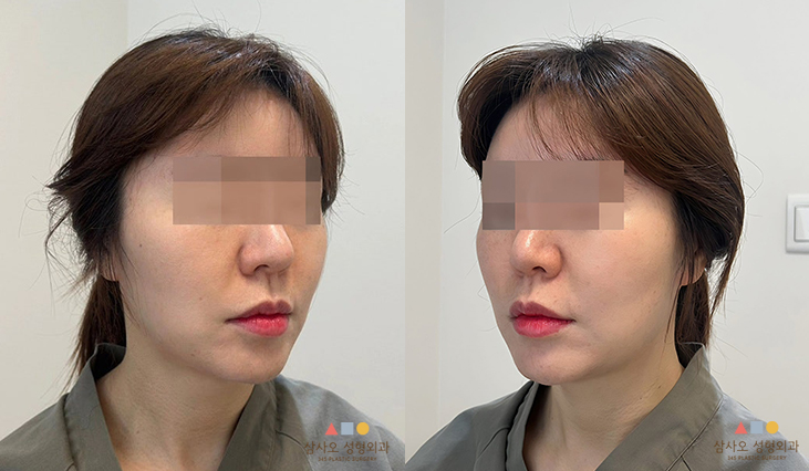 수술 전