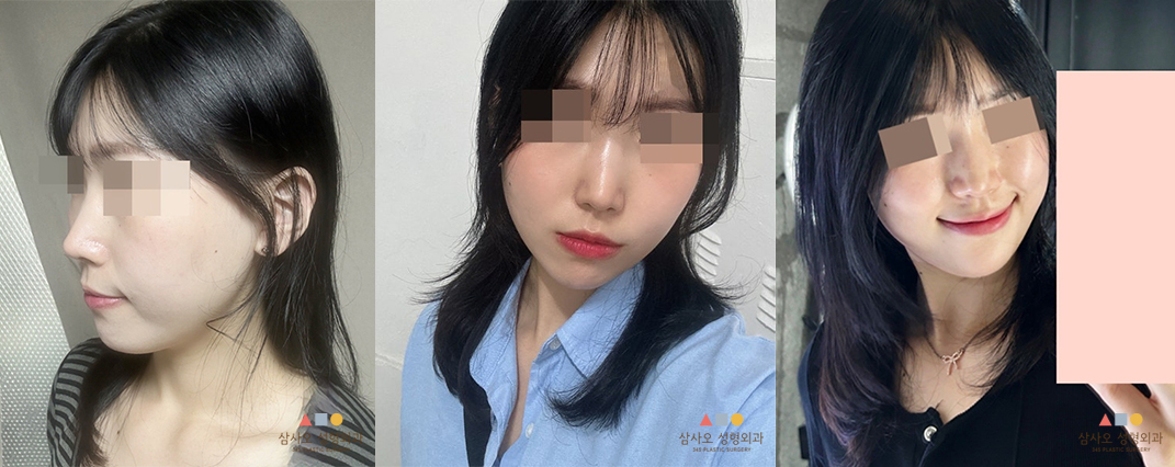수술 후