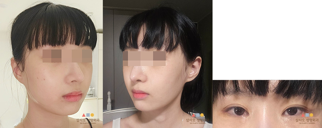 수술 후