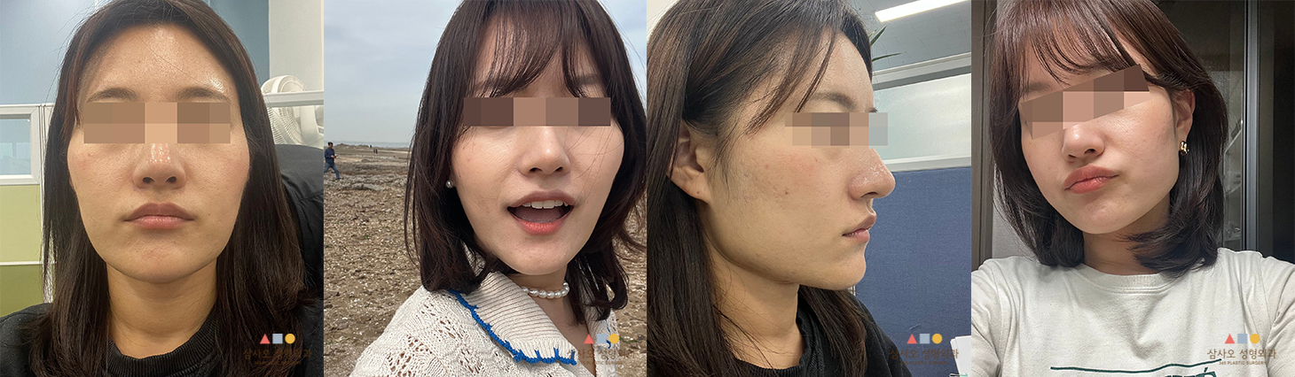 수술 전