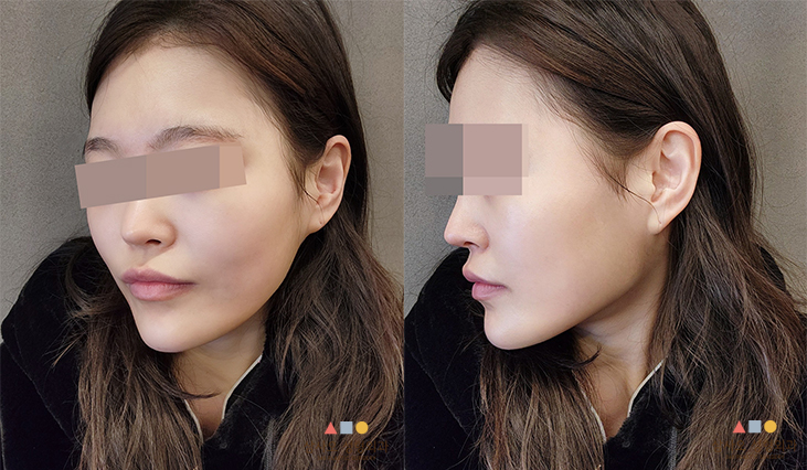 수술 전