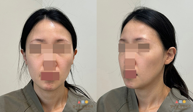 수술 전
