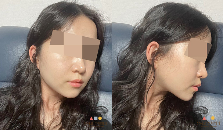 수술 후