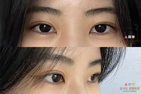 수술 후