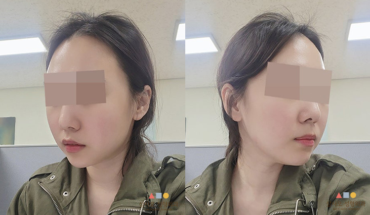 수술 후