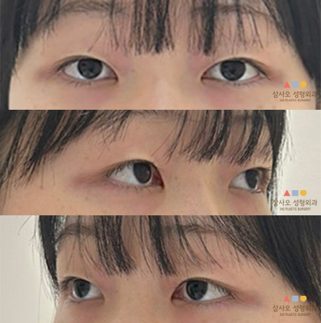 수술 전