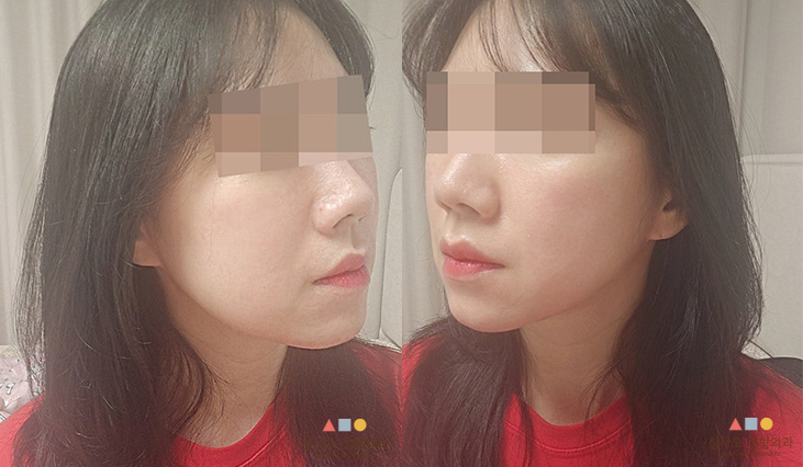 수술 후