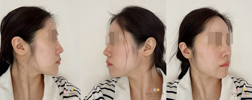 수술 후