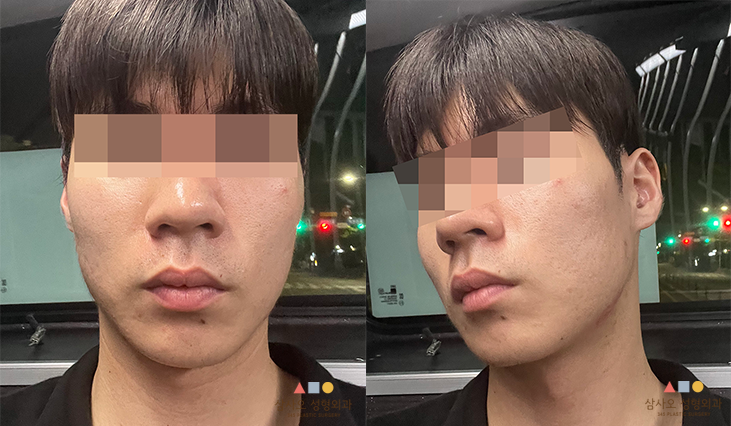 수술 후