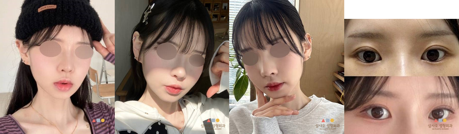 수술 후
