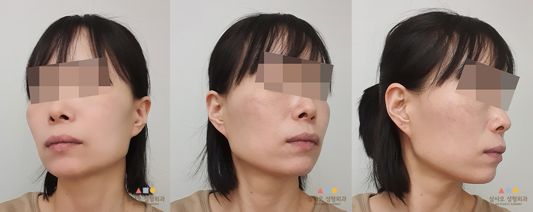 수술 전