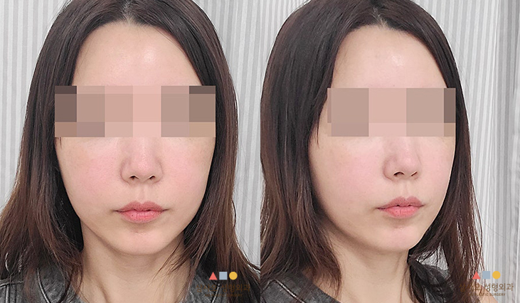 수술 후