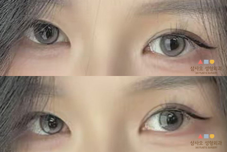 수술 후