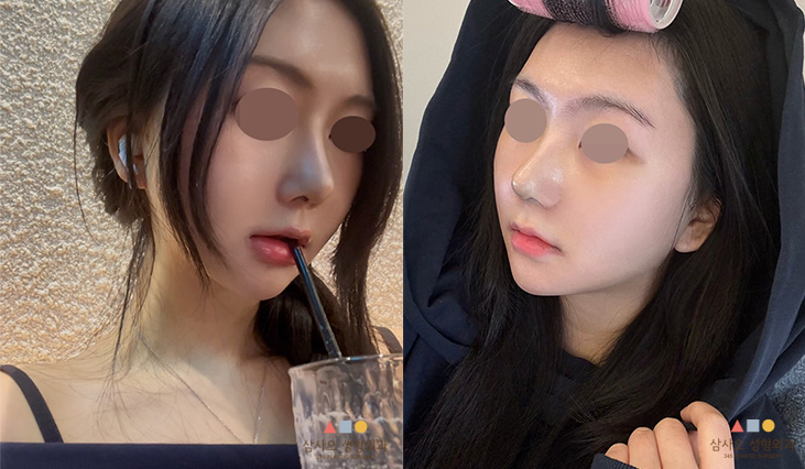 수술 후