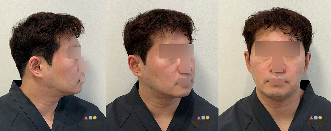 수술 전