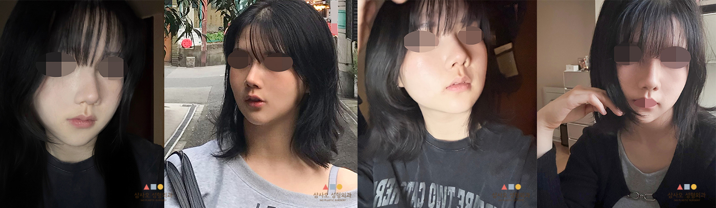 수술 후